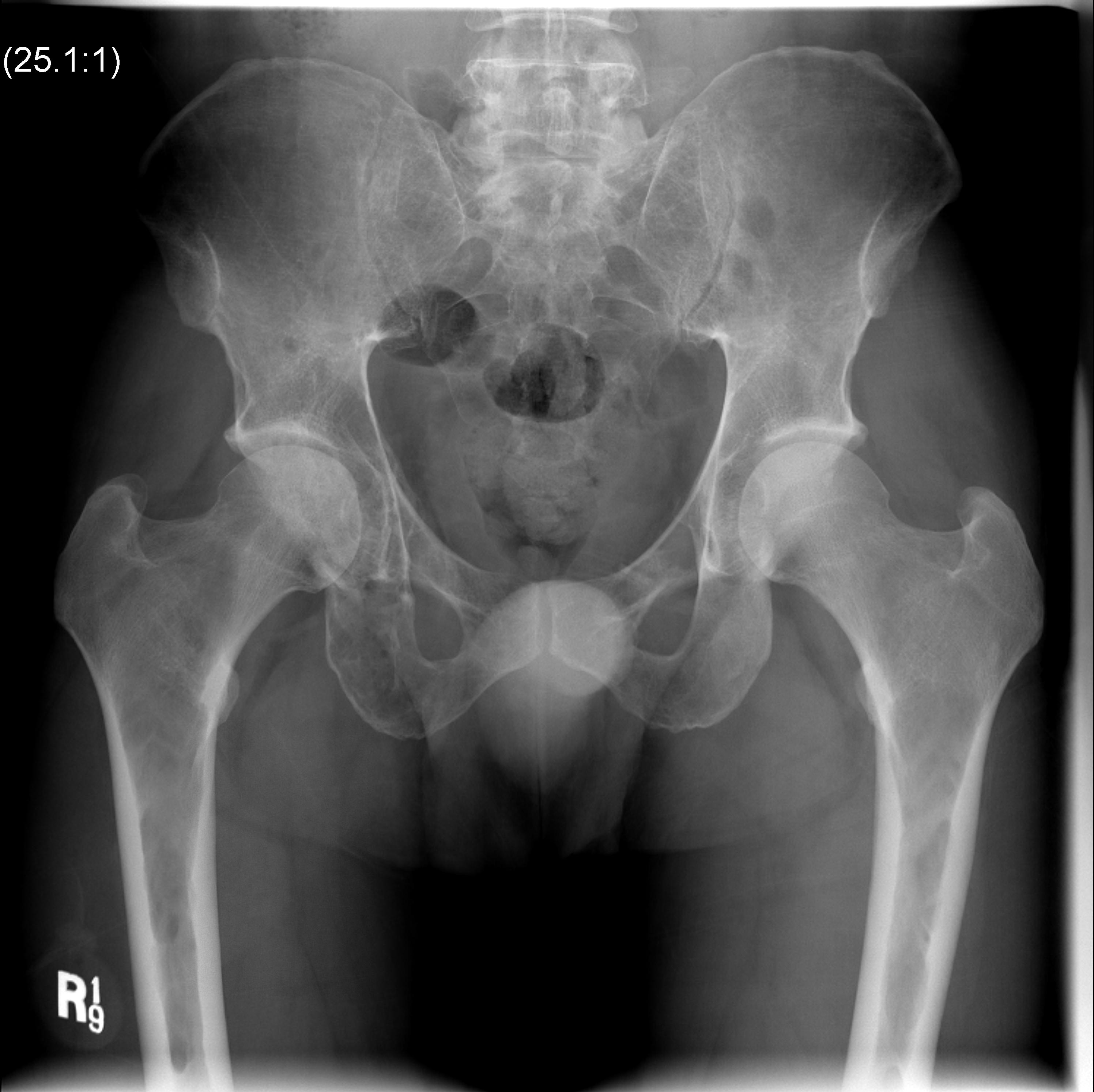 Multiple Myeloma Pelvis0002